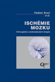 Ischémie mozku